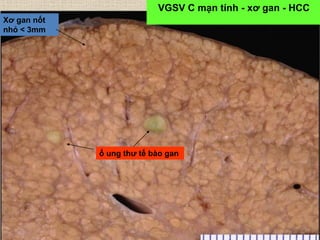 VGSV C mạn tính - xơ gan - HCC
Xơ gan nốt
nhỏ < 3mm
ổ ung thƣ tế bào gan
 