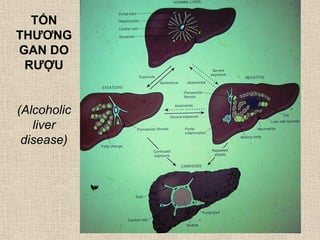 TỔN
THƢƠNG
GAN DO
RƢỢU
(Alcoholic
liver
disease)
 