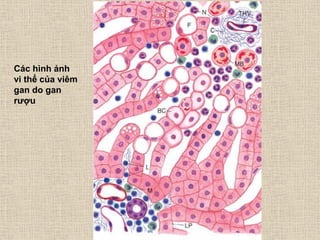 Các hình ảnh
vi thể của viêm
gan do gan
rƣợu
 