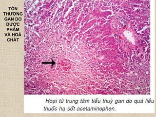 TỔN
THƢƠNG
GAN DO
DƢỢC
PHẨM
VÀ HOÁ
CHẤT
 