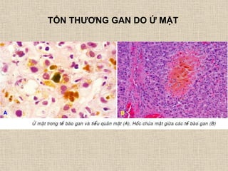 TỔN THƢƠNG GAN DO Ứ MẬT
 