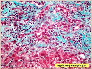 Hẹp đƣờng mật ngoài gan
 