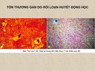 TỔN THƢƠNG GAN DO RỐI LOẠN HUYẾT ĐỘNG HỌC
 