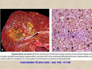 CARCINOMA TẾ BÀO GAN – ĐẠI THỂ - VI THỂ
 