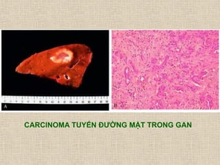 CARCINOMA TUYẾN ĐƢỜNG MẬT TRONG GAN
 