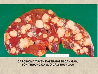 CARCINOMA TUYẾN ĐẠI TRÀNG DI CĂN GAN,
TỔN THƢƠNG ĐA Ổ, Ở CẢ 2 THÙY GAN
 