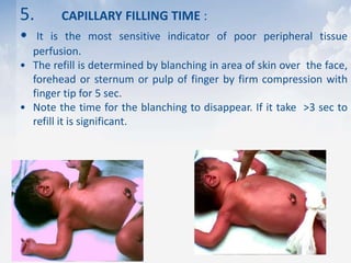 5. CAPILLARY FILLING TIME :
• It is the most sensitive indicator of poor peripheral tissue
perfusion.
• The refill is determined by blanching in area of skin over the face,
forehead or sternum or pulp of finger by firm compression with
finger tip for 5 sec.
• Note the time for the blanching to disappear. If it take >3 sec to
refill it is significant.
 