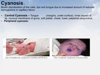 Cyanosis–
Bluish discoloration of the nalis, lips and tongue due to increased amount of reduced
hemoglobine in capillary blood.
• Central Cyanosis – Tongue (margins, under surface), Inner aspect of
lip, mucous membrane of gums, soft palate, cheek, lower palpebral conjunctiva.
• Peripheral cyanosis-
 