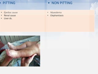 • Cardiac cause
• Renal cause
• Liver ds.
• Myxodema
• Elephantiasis
• PITTING • NON PITTING
 