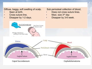 Caput succedaneum Cephalohematoma
Diffuse, baggy, soft swelling of scalp.
• Seen at birth.
• Cross suture line.
• Disapper by 1-2 days.
Sub periosteal collection of blood,
• Does not cross suture lines.
• Maxi. size 3rd day
• Disapper by 3-6 week.
 