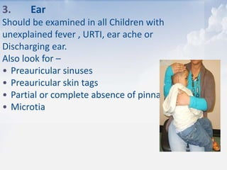3. Ear
Should be examined in all Children with
unexplained fever , URTI, ear ache or
Discharging ear.
Also look for –
• Preauricular sinuses
• Preauricular skin tags
• Partial or complete absence of pinna
• Microtia
 
