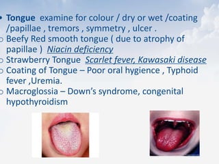 • Tongue examine for colour / dry or wet /coating
/papillae , tremors , symmetry , ulcer .
o Beefy Red smooth tongue ( due to atrophy of
papillae ) Niacin deficiency
o Strawberry Tongue Scarlet fever, Kawasaki disease
o Coating of Tongue – Poor oral hygience , Typhoid
fever ,Uremia.
o Macroglossia – Down’s syndrome, congenital
hypothyroidism
 