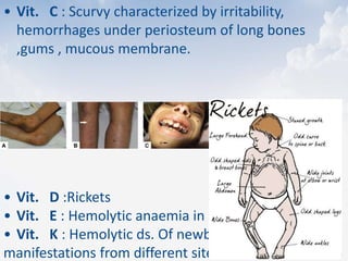 • Vit. C : Scurvy characterized by irritability,
hemorrhages under periosteum of long bones
,gums , mucous membrane.
• Vit. D :Rickets
• Vit. E : Hemolytic anaemia in preterm babies
• Vit. K : Hemolytic ds. Of newborn with bleeding
manifestations from different sites
 