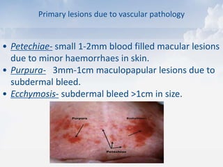 Primary lesions due to vascular pathology
• Petechiae- small 1-2mm blood filled macular lesions
due to minor haemorrhaes in skin.
• Purpura- 3mm-1cm maculopapular lesions due to
subdermal bleed.
• Ecchymosis- subdermal bleed >1cm in size.
 