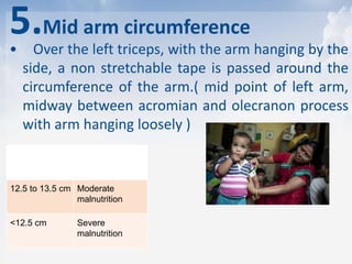 5.Mid arm circumference
• Over the left triceps, with the arm hanging by the
side, a non stretchable tape is passed around the
circumference of the arm.( mid point of left arm,
midway between acromian and olecranon process
with arm hanging loosely )
>13.5 cm Normal
12.5 to 13.5 cm Moderate
malnutrition
<12.5 cm Severe
malnutrition
 