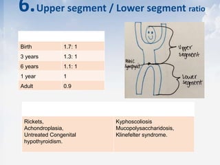 6.Upper segment / Lower segment ratio
Age US/LS ratio
Birth 1.7: 1
3 years 1.3: 1
6 years 1.1: 1
1 year 1
Adult 0.9
Increase Decrease
Rickets,
Achondroplasia,
Untreated Congenital
hypothyroidism.
Kyphoscoliosis
Mucopolysaccharidosis,
Klinefelter syndrome.
 