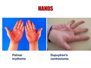 HANDS
Palmar
erythema
Dupuytren’s
contractures
 
