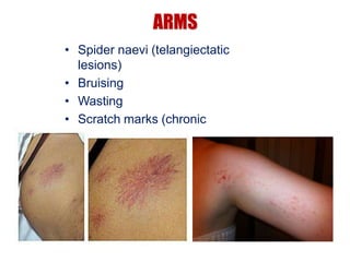 ARMS
• Spider naevi (telangiectatic
lesions)
• Bruising
• Wasting
• Scratch marks (chronic
cholestasis)
 
