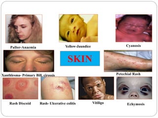 SKIN
Pallor-Anaemia
EchymosisRash Discoid Rash- Ulcerative colitis
Petechial Rash
CyanosisYellow-Jaundice
Xanthlesma- Primary Bill. cirossis
Vitiligo
 