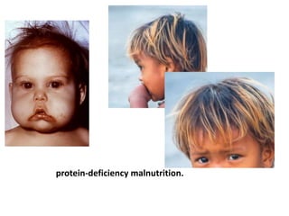 protein-deficiency malnutrition.
 