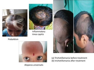 Piebaldism
Inflammatory
tinea capitis
Alopecia universalis
(a) Trichotillomania before treatment
(b) trichotillomania after treatment
 