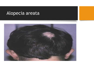 Alopecia areata
 