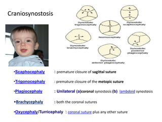 Craniosynostosis
•Scaphocephaly : premature closure of sagittal suture
•Trigonocephaly : premature closure of the metopic suture
•Plagiocephaly : Unilateral (a)coronal synostosis (b) lambdoid synostosis
•Brachycephaly : both the coronal sutures
•Oxycephaly/Turricephaly : coronal suture plus any other suture
 