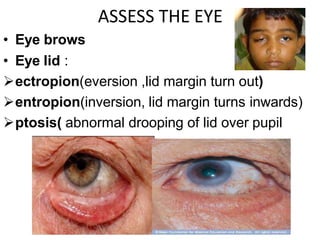 ASSESS THE EYE
• Eye brows
• Eye lid :
ectropion(eversion ,lid margin turn out)
entropion(inversion, lid margin turns inwards)
ptosis( abnormal drooping of lid over pupil
 