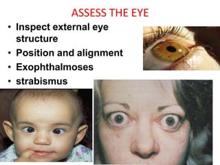 ASSESS THE EYE
• Inspect external eye
structure
• Position and alignment
• Exophthalmoses
• strabismus
 