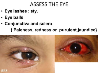 ASSESS THE EYE
• Eye lashes : sty.
• Eye balls
• Conjunctiva and sclera
{ Paleness, redness or purulent,jaundice}
 