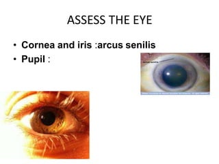 ASSESS THE EYE
• Cornea and iris :arcus senilis
• Pupil :
 