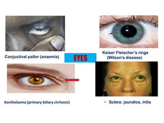 Xanthelasma (primary biliary cirrhosis)
EYESConjuctival pallor (anaemia)
• Sclera: jaundice, iritis
Kaiser Fleischer’s rings
(Wilson’s disease)
 