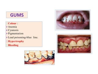 GUMS
Colour :
Anemia
Cyanosis
Pigmentation
Lead poisoning-blue line.
Hypertrophy
Bleeding
 