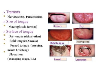 Tremors Dry
Macroglossia
 Tremors
Nervousness, Parkinsonism
 Size of tongue
Macroglossia (cretins)
 Surface of tongue
Dry tongue (dehydration)
Bald tongue (Anemia)
Furred tongue (smoking,
mouth breathing)
Ulceration
(Whooping cough, T.B.) furred Ulceration
Bald tongue
 