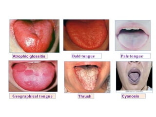 Atrophic glossitis
ThrushGeographical tongue
Bald tongue Pale tongue
Cyanosis
 