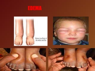 EDEMA
 