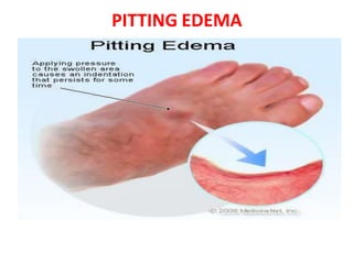 PITTING EDEMA
 