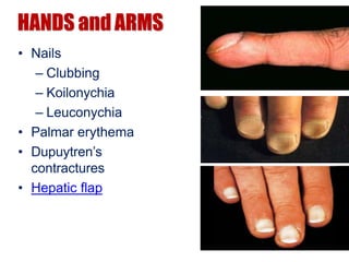 HANDS and ARMS
• Nails
– Clubbing
– Koilonychia
– Leuconychia
• Palmar erythema
• Dupuytren’s
contractures
• Hepatic flap
 