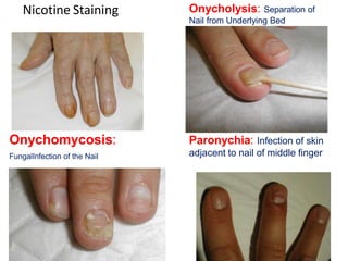 Nicotine Staining Onycholysis: Separation of
Nail from Underlying Bed
Onychomycosis:
FungalInfection of the Nail
Paronychia: Infection of skin
adjacent to nail of middle finger
 