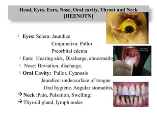 Head, Eyes, Ears, Nose, Oral cavity, Throat and Neck
[HEENOTN]
 Eyes: Sclera: Jaundice
Conjunctiva: Pallor
Preorbital edema
Ears: Hearing aids, Discharge, abnormality…
 Nose: Deviation, discharge,
Oral Cavity: Pallor, Cyanosis
Jaundice: undersurface of tongue
Oral hygiene. Angular stomatitis, teeth caries
Neck :Pain, Pulsation, Swelling:
Thyroid gland, lymph nodes
 