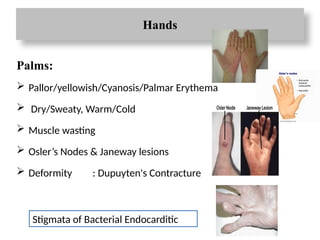 Hands
Palms:
 Pallor/yellowish/Cyanosis/Palmar Erythema
 Dry/Sweaty, Warm/Cold
 Muscle wasting
 Osler’s Nodes & Janeway lesions
 Deformity : Dupuyten's Contracture
Stigmata of Bacterial Endocarditic
 