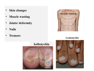 • Skin changes
• Muscle wasting
• Joints/ deformity
• Nails
• Tremors
koilonychia
Muscle wasting
 