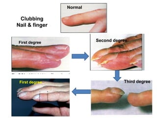 Normal
First degree Second degree
Third degree
First degree
Clubbing
Nail & finger
 