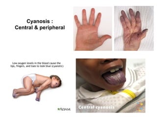 Cyanosis :
Central & peripheral
 