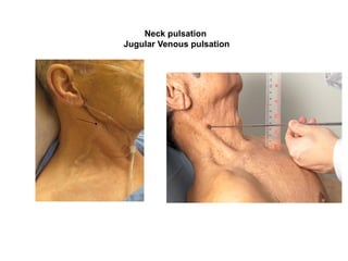 Neck pulsation
Jugular Venous pulsation
 