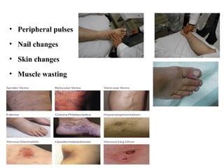 • Peripheral pulses
• Nail changes
• Skin changes
• Muscle wasting
 