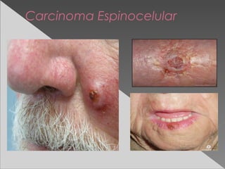 Carcinoma Espinocelular
 
