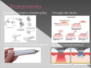 Tratamento
Excisão cirúrgica (ressecção) Cirurgia de Mohs
Pomadas imunomoduladoras Terapia fotodinâmica
 