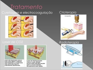 Tratamento
CrioterapiaCuretagem e electrocoagulação
Laser de CO2 Radioterapia
 