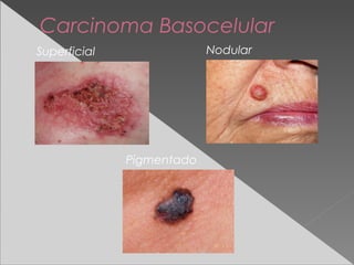 Carcinoma Basocelular
Superficial Nodular
Pigmentado
 
